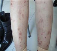 什么是關節型牛皮癬呢