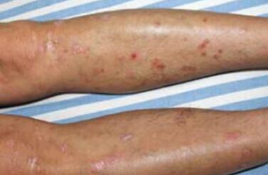 關節病型牛皮癬患者吃什么改善不適癥狀