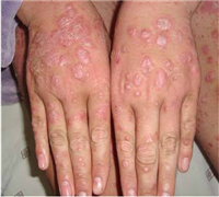 　　關節型牛皮癬屬于牛皮癬中比較嚴重的一種，其發病癥狀是在患者的關節及關節周圍處發生炎癥，進而使得患處的骨質遭到損害從而引起關節處的變形。那么患有關節型牛皮癬有什么危害呢。  　　1、關節型牛皮癬多與膿皰性型牛皮癬并發，常伴有高熱、貧血等癥狀，類風濕因子多陰性，患者若不及時的治療可以發一系列的并發癥，可造成風濕性心臟病、脾及淋巴結腫大等危害。  　　2、關節型牛皮癬主要使得的患者的關節受到嚴重的損傷，一般發生在近端指間關節，掌指關節，足和四肢大關節膝、肘等，社會的患者的關節腫脹、僵直，活動受限等。  　　3、除皮膚關節表現外，有的患者的手指或足趾甲也受到影響，表現為甲板增厚、渾濁，甚至發烏發白，表面可高低不平有橫溝，嚴重時可有甲剝脫，患者需多多了解一下。  　　4、患者的癥狀表現為對稱性關節炎，與類風濕性關節炎相似。易發生骶髂關節病變，影響到脊柱的病人以男性多見，是不同人們會使得一類疾病。  　　關節病型牛皮癬對患者的危害極大，因此，患者朋友需及早進行治療，防止疾病的發展，進一步危害身體健康。