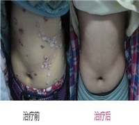 紅皮病型牛皮癬的護理都有哪些