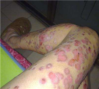 尋常型牛皮癬患者會不會感到癢呢