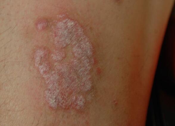 銀屑病日常注意事項你可弄清楚了