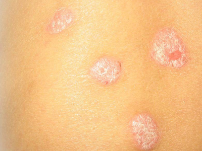 在如何選擇銀屑病醫院這個問題