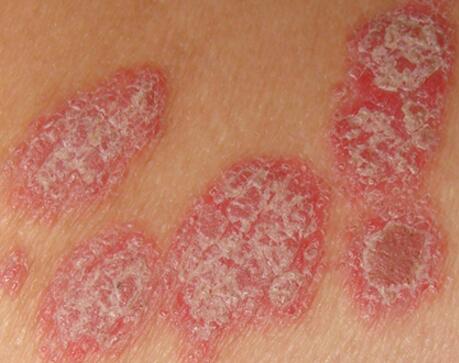 張英醫生強調糾正兒童銀屑病患