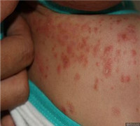 銀屑病食療方法有哪些呢