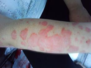 臧亞麗醫生警示兒童飲食不科學也會引發銀屑