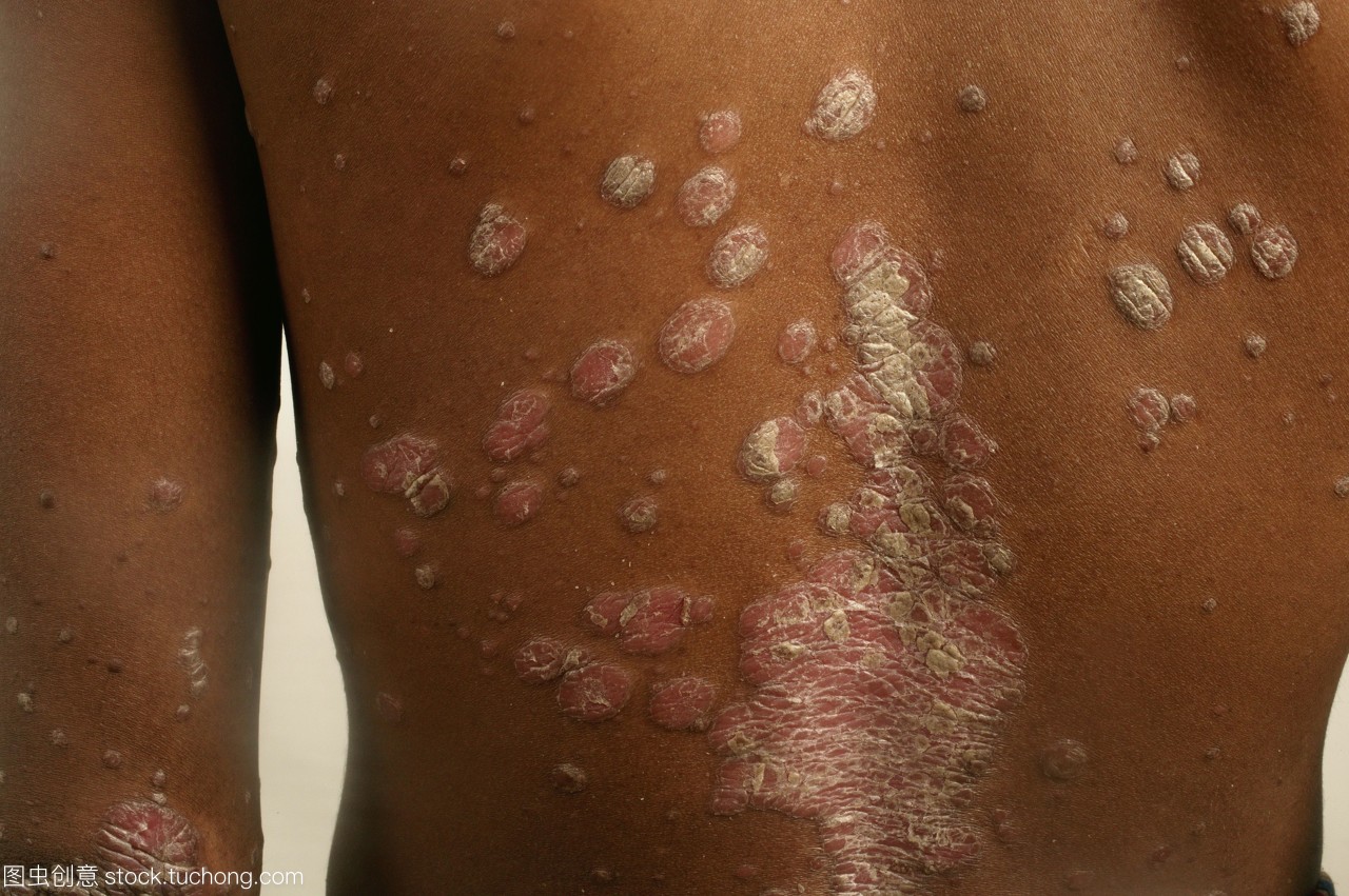 牛皮癬 牛皮癬