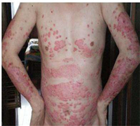 西安治療牛皮癬最好的醫院